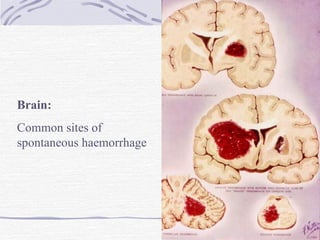 Brain: Common sites of spontaneous haemorrhage 
