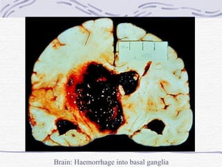 Brain: Haemorrhage into basal ganglia 