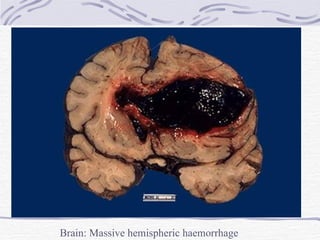 Brain: Massive hemispheric haemorrhage 