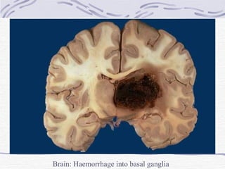 Brain: Haemorrhage into basal ganglia 