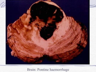 Brain: Pontine haemorrhage 