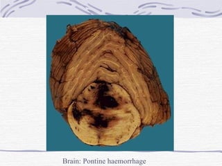 Brain: Pontine haemorrhage 