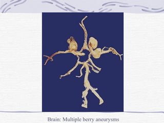 Brain: Multiple berry aneurysms 