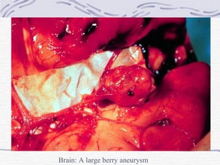 Brain: A large berry aneurysm 
