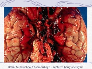 Brain: Subarachnoid haemorrhage – ruptured berry aneurysm 