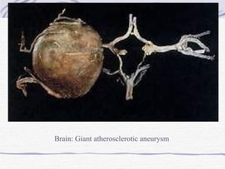 Brain: Giant atherosclerotic aneurysm 