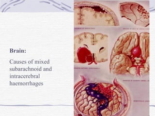 Brain: Causes of mixed subarachnoid and intracerebral haemorrhages 