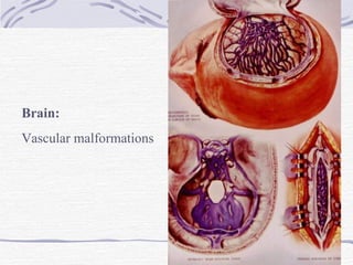 Brain: Vascular malformations 