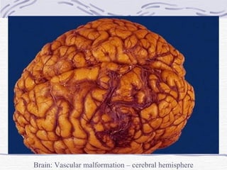Brain: Vascular malformation – cerebral hemisphere 