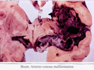 Brain: Arterio-venous malformation 