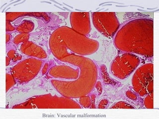 Brain: Vascular malformation 