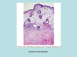 Ovarian endometriosis
 