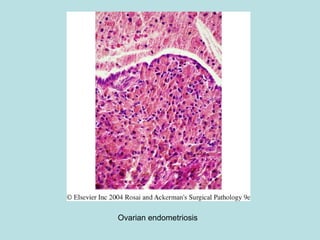 Ovarian endometriosis
 