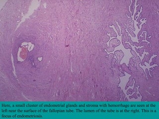 Here, a small cluster of endometrial glands and stroma with hemorrhage are seen at the
left near the surface of the fallopian tube. The lumen of the tube is at the right. This is a
focus of endometriosis.
 