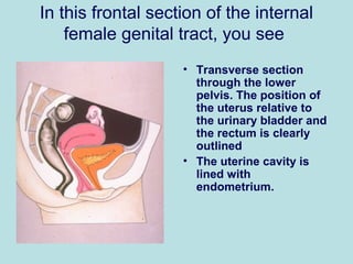 In this frontal section of the internal
female genital tract, you see
• Transverse section
through the lower
pelvis. The position of
the uterus relative to
the urinary bladder and
the rectum is clearly
outlined
• The uterine cavity is
lined with
endometrium.
 