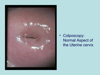 • Colposcopy:
Normal Aspect of
the Uterine cervix
 
