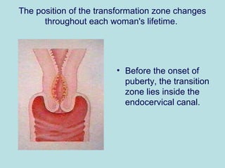 The position of the transformation zone changes
throughout each woman's lifetime.
• Before the onset of
puberty, the transition
zone lies inside the
endocervical canal.
 