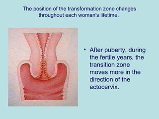 The position of the transformation zone changes
throughout each woman's lifetime.
• After puberty, during
the fertile years, the
transition zone
moves more in the
direction of the
ectocervix.
 