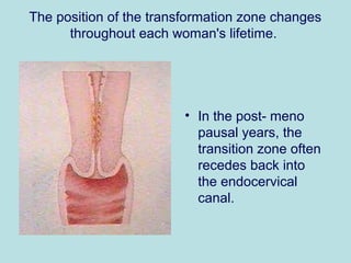 The position of the transformation zone changes
throughout each woman's lifetime.
• In the post- meno
pausal years, the
transition zone often
recedes back into
the endocervical
canal.
 