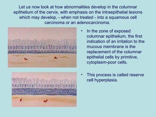Let us now look at how abnormalities develop in the columnar
epithelium of the cervix, with emphasis on the intraepithelial lesions
which may develop, - when not treated - into a squamous cell
carcinoma or an adenocarcinoma.
• In the zone of exposed
columnar epithelium, the first
indication of an irritation to the
mucous membrane is the
replacement of the columnar
epithelial cells by primitive,
cytoplasm-poor cells.
• This process is called reserve
cell hyperplasia.
 