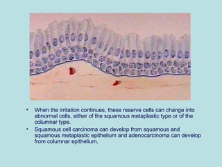 • When the irritation continues, these reserve cells can change into
abnormal cells, either of the squamous metaplastic type or of the
columnar type.
• Squamous cell carcinoma can develop from squamous and
squamous metaplastic epithelium and adenocarcinoma can develop
from columnar epithelium.
 