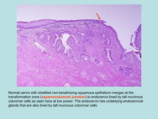 Normal cervix with stratified non-keratinizing squamous epithelium merges at the
transformation zone (squamocolumnar junction) to endocervix lined by tall mucinous
columnar cells as seen here at low power. The endocervix has underlying endocervical
glands that are also lined by tall mucinous columnar cells.
 