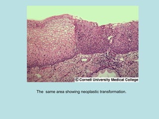 The same area showing neoplastic transformation.
 