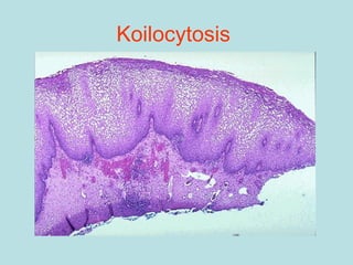 Koilocytosis
 
