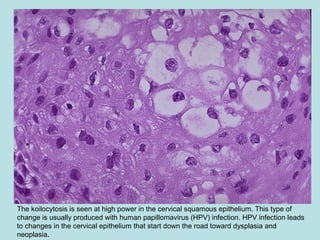 The koilocytosis is seen at high power in the cervical squamous epithelium. This type of
change is usually produced with human papillomavirus (HPV) infection. HPV infection leads
to changes in the cervical epithelium that start down the road toward dysplasia and
neoplasia.
 
