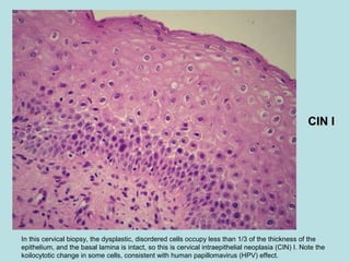 In this cervical biopsy, the dysplastic, disordered cells occupy less than 1/3 of the thickness of the
epithelium, and the basal lamina is intact, so this is cervical intraepithelial neoplasia (CIN) I. Note the
koilocytotic change in some cells, consistent with human papillomavirus (HPV) effect.
CIN ICIN I
 