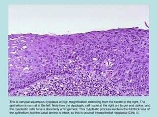 This is cervical squamous dysplasia at high magnification extending from the center to the right. The
epithelium is normal at the left. Note how the dysplastic cell nuclei at the right are larger and darker, and
the dysplastic cells have a disorderly arrangement. This dysplastic process involves the full thickness of
the epithelium, but the basal lamina is intact, so this is cervical intraepithelial neoplasia (CIN) III.
 