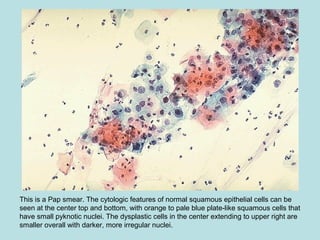 This is a Pap smear. The cytologic features of normal squamous epithelial cells can be
seen at the center top and bottom, with orange to pale blue plate-like squamous cells that
have small pyknotic nuclei. The dysplastic cells in the center extending to upper right are
smaller overall with darker, more irregular nuclei.
 