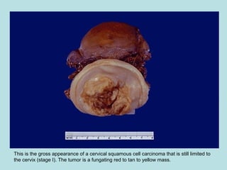 This is the gross appearance of a cervical squamous cell carcinoma that is still limited to
the cervix (stage I). The tumor is a fungating red to tan to yellow mass.
 