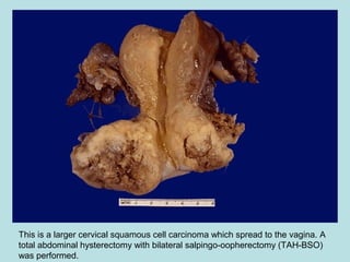 This is a larger cervical squamous cell carcinoma which spread to the vagina. A
total abdominal hysterectomy with bilateral salpingo-oopherectomy (TAH-BSO)
was performed.
 