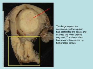 This large squamous
carcinoma (yellow square)
has obliterated the cervix and
invaded the lower uterine
segment. The uterus also
has a round leiomyoma up
higher (Red arrow).
 