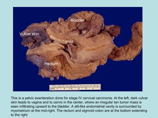 This is a pelvic exenteration done for stage IV cervical carcinoma. At the left, dark vulvar
skin leads to vagina and to cervix in the center, where an irregular tan tumor mass is
seen infiltrating upward to the bladder. A slit-like endometrial cavity is surrounded by
myometrium at the mid-right. The rectum and sigmoid colon are at the bottom extending
to the right
Vulvar skin
Tumor
Rectum
Bladder
 