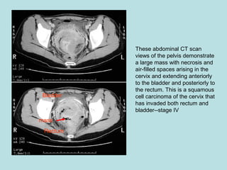 These abdominal CT scan
views of the pelvis demonstrate
a large mass with necrosis and
air-filled spaces arising in the
cervix and extending anteriorly
to the bladder and posteriorly to
the rectum. This is a squamous
cell carcinoma of the cervix that
has invaded both rectum and
bladder--stage IV
mass
Bladder
Rectum
 