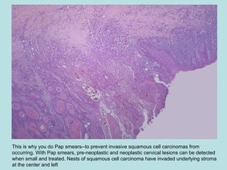 This is why you do Pap smears--to prevent invasive squamous cell carcinomas from
occurring. With Pap smears, pre-neoplastic and neoplastic cervical lesions can be detected
when small and treated. Nests of squamous cell carcinoma have invaded underlying stroma
at the center and left
 