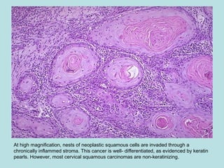 At high magnification, nests of neoplastic squamous cells are invaded through a
chronically inflammed stroma. This cancer is well- differentiated, as evidenced by keratin
pearls. However, most cervical squamous carcinomas are non-keratinizing.
 
