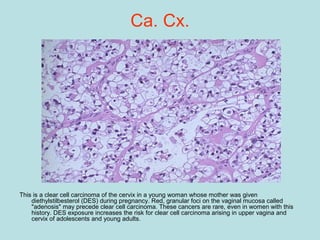 Ca. Cx.
This is a clear cell carcinoma of the cervix in a young woman whose mother was given
diethylstilbesterol (DES) during pregnancy. Red, granular foci on the vaginal mucosa called
"adenosis" may precede clear cell carcinoma. These cancers are rare, even in women with this
history. DES exposure increases the risk for clear cell carcinoma arising in upper vagina and
cervix of adolescents and young adults.
 
