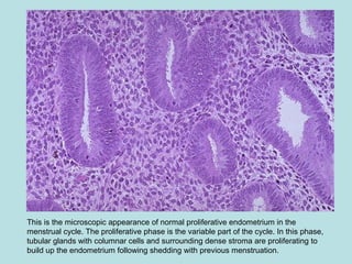 This is the microscopic appearance of normal proliferative endometrium in the
menstrual cycle. The proliferative phase is the variable part of the cycle. In this phase,
tubular glands with columnar cells and surrounding dense stroma are proliferating to
build up the endometrium following shedding with previous menstruation.
 