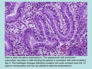 Here is early secretory endometrium. The appearance with prominent
subnuclear vacuoles in cells forming the glands is consistent with post-ovulatory
day 2. The histologic changes following ovulation are quite constant over the 14
days to menstruation and can be utilized to date the endometrium.
 