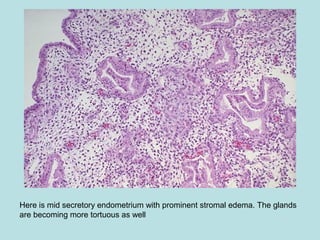 Here is mid secretory endometrium with prominent stromal edema. The glands
are becoming more tortuous as well
 