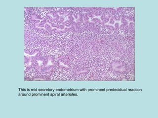This is mid secretory endometrium with prominent predecidual reaction
around prominent spiral arterioles.
 