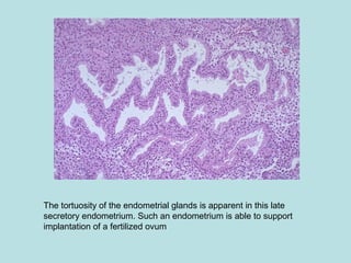 The tortuosity of the endometrial glands is apparent in this late
secretory endometrium. Such an endometrium is able to support
implantation of a fertilized ovum
 