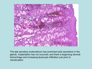 The late secretory endometrium has prominent pink secretions in the
glands. Implantation has not occurred, and there is beginning stromal
hemorrhage and increasing leukocyte infiltration just prior to
menstruation
 