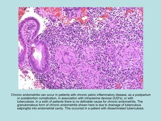 Chronic endometritis can occur in patients with chronic pelvic inflammatory disease, as a postpartum
or postabortion complication, in association with intrauterine devices (IUD's), or with
tuberculosis. In a sixth of patients there is no definable cause for chronic endometritis. The
granulomatous form of chronic endometritis shown here is due to drainage of tuberculous
salpingitis into endometrial cavity. This occurred in a patient with disseminated tuberculosis.
 