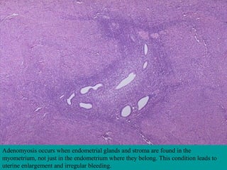 Adenomyosis occurs when endometrial glands and stroma are found in the
myometrium, not just in the endometrium where they belong. This condition leads to
uterine enlargement and irregular bleeding.
 