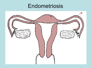 Endometriosis
 