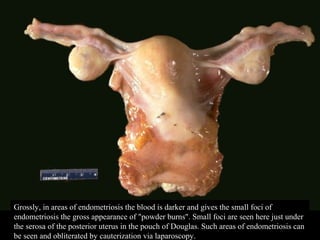 Grossly, in areas of endometriosis the blood is darker and gives the small foci of
endometriosis the gross appearance of "powder burns". Small foci are seen here just under
the serosa of the posterior uterus in the pouch of Douglas. Such areas of endometriosis can
be seen and obliterated by cauterization via laparoscopy.
 